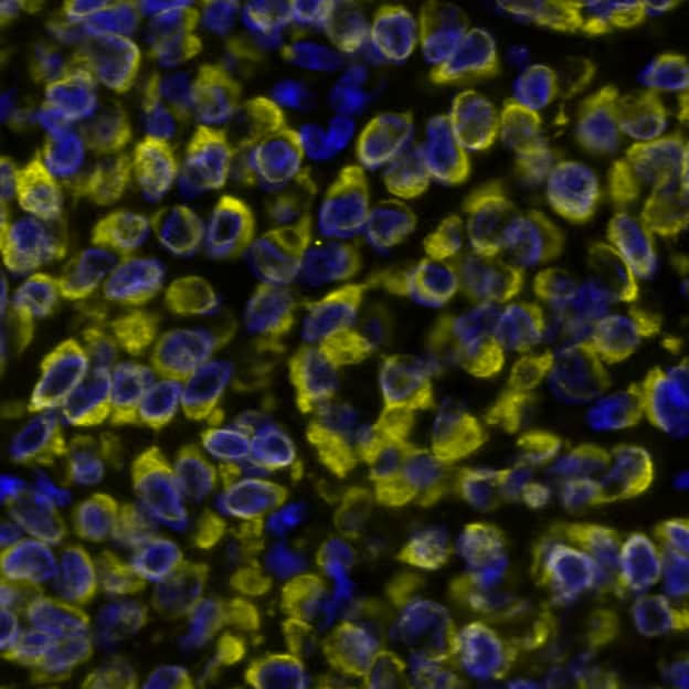 Pan-Cytokeratin was detected in immersion fixed paraffin-embedded sections of human Breast Tumor using Mouse Anti-Human Cytokeratin, pan Monoclonal Antibody (Catalog # NBP2-29429) at 1:500 at 37 ° Celsius for 4 minutes. Before incubation with the primary antibody, tissue underwent an all-in-one dewaxing and antigen retrieval preprocessing using PreTreatment Module (PT Module) and Dewax and HIER Buffer H (pH 9; Epredia Catalog # TA-999-DHBH). Tissue was stained using the Alexa Fluor™ 555 Goat anti-Mouse IgG Secondary Antibody at 1:100 at 37 ° Celsius for 2 minutes. (Yellow; Lunaphore Catalog # DR555MS) and counterstained with DAPI (blue; Lunaphore Catalog # DR100). Specific staining was localized to the cytoplasm. Protocol available in COMET™ Panel Builder.